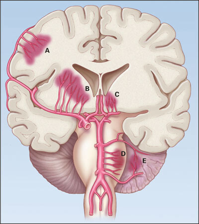Figur 1 Skjematisk koronarsnitt av hjernen med fremstilling av de vanligste lokalisasjoner for intracerebral blødning…