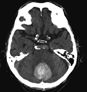 Figur 3 CT-undersøkelse av 77 år gammel pasient med cerebellær blødning. 4. ventrikkel er helt komprimert, det er et…
