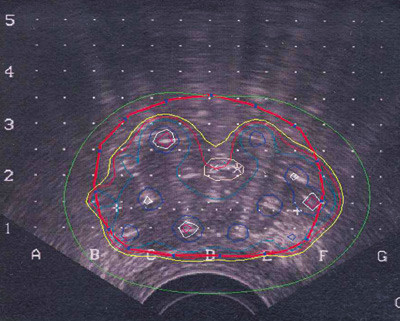 Figure 1 Isodose lines in the prostate representing different dose percentages through a slice of the gland. The thick red…
