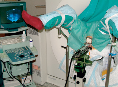 Figure 2 A patient in position for high-dose-rate brachytherapy: An ultrasound probe is placed in the rectum and a…