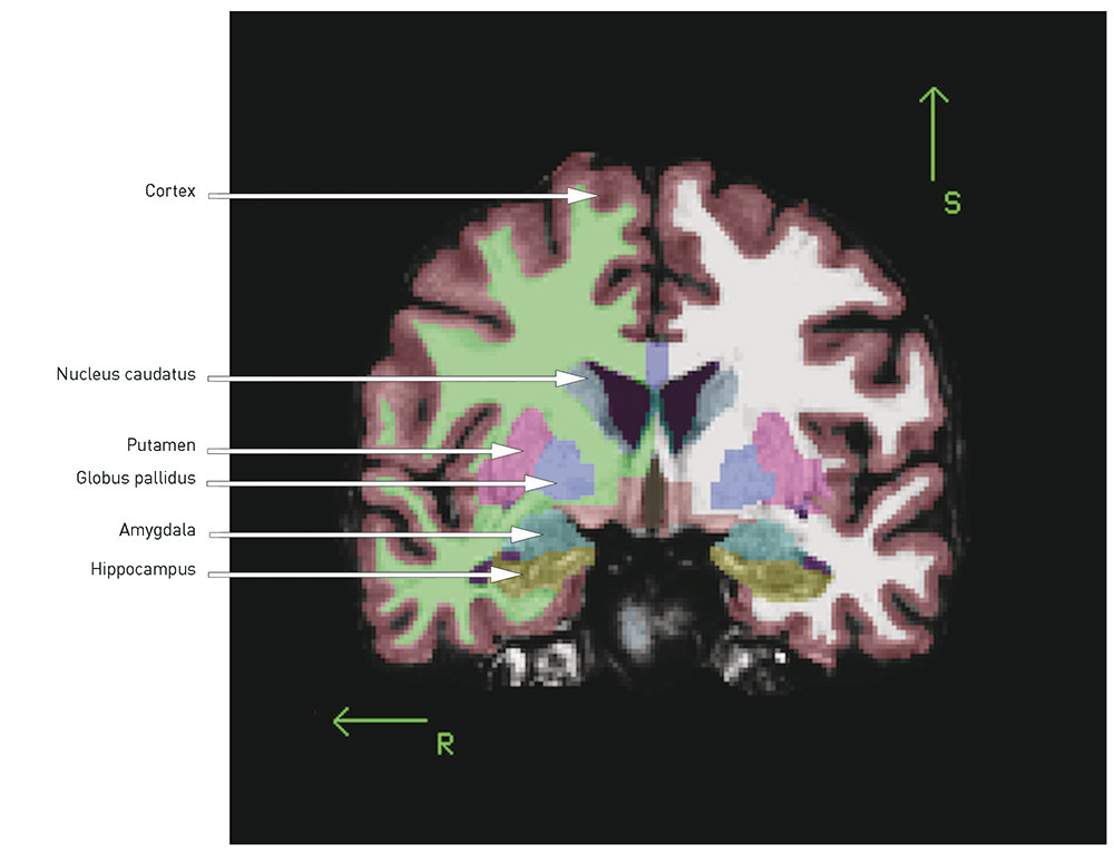 Fig. 1 Coronal section of T1-weighted MR image, automatic volume estimation using MRI post-processing tool FreeSurfer. R =…