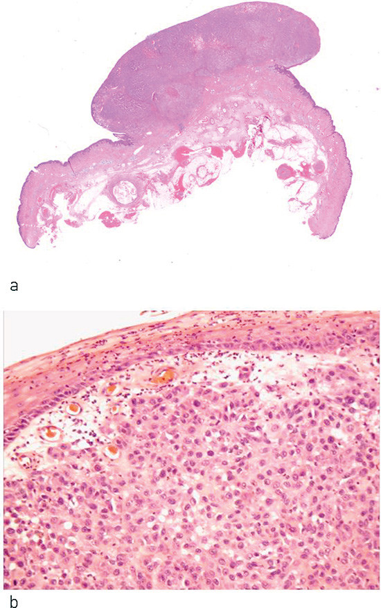Figure 1 a) Polypoid malignant melanoma of nodular subtype, b) Diffuse (undifferentiated) growth of strongly atypical cells…
