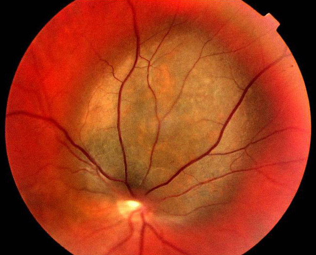 Figure 4 Malignant melanoma starting in the eye. Photo Nils A. Eide