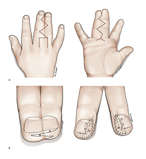 Figure 3 Example of a plasty for separation of syndactyly between the long and ring finger. a) Planning sketch from the…