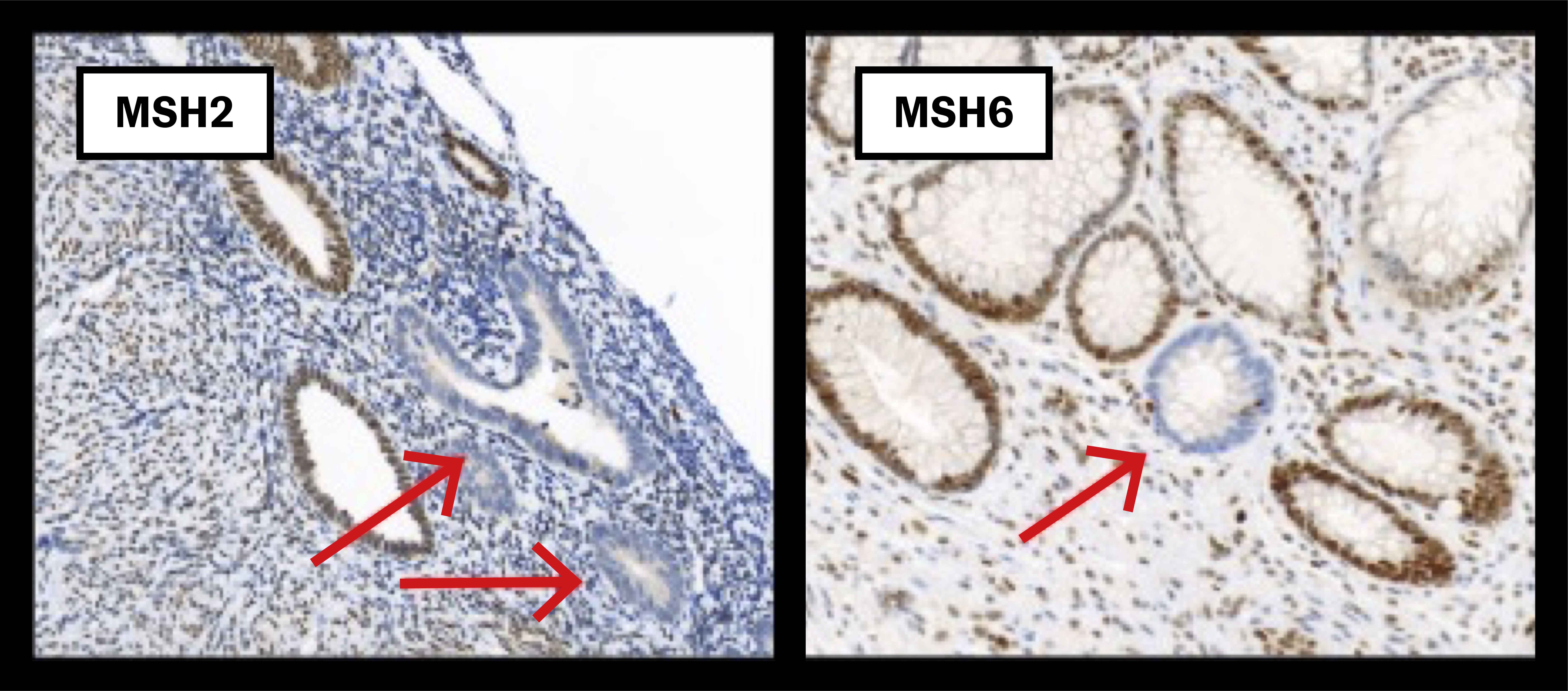 Immunhistokjemisk påvisning av tarmkrypter som mangler genproduktet (dMMR-celler) av henholdsvis MSH2 og MSH6 hos bærere av…