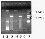 Figur 3    Etidiumbromidfarget gel ved PCR-undersøkelse for t(11;14). Brønn 1, 2 og 4 negativ reaksjon for pasient 1, 2 og 5…