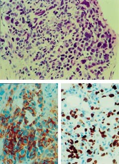 Figur 4    Biopsi fra høygradig malignt non-Hodgkinslymfom av T-celletype fra pasient 4. a) Hematoksylin/eosin/safran-farget…