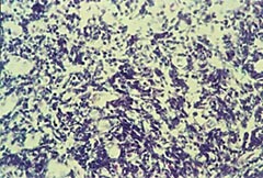 Figur 5    Traumatisert biopsi fra pasient 5. Cellene er sammenklemte med deformerte og hyperkromatiske kjerner. Uegnet til…