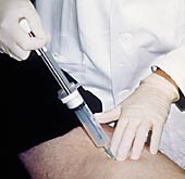 Figur 1    Finnålspunksjon av palpabel tumor på låret. Ved å trekke opp stempelet i aspirator samtidig som nålen føres frem…