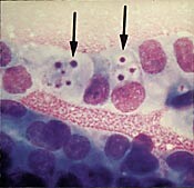 Figur 2    Adenokarsinomceller fremstilt ved Diff-Quick-farging. Ved pilmerkene sees intracytoplasmatiske vakuoler som først…