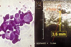 Figur 3    a) Diff-Quick-farget finnålsaspirat fra tumor på halsen. Mikroskopisk sees karsinomceller og kolloid forenlig med…