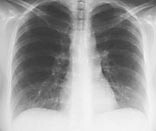 Figur 1  Normal røntgen thorax ved innkomst