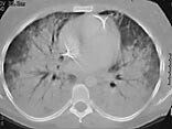 Figur 3  CT thorax-bilde tatt 36 timer etter innkomst, omfattende konsolidering med luftbronkogrammer