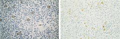 Figur 2  Immunhistokjemisk fargede snitt av formalinfiksert, parafininnstøpt cytoblokk.  a) Positivitet for CA 125.  b)…