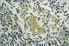 Figur 1  Celleblokk av ascitesvæske med lymfocytter, mesotelceller og karsinomceller med tydelig membranfarging for Ber-EP4