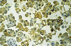 Figur 2  Ascitesvæske med et stort antall karsinomceller med både membranøs og cytoplasmatisk immunreaktivitet for B-72.3