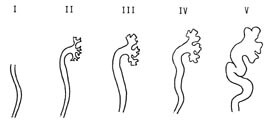  Figur 2    Det internasjonale graderinssystemet for vesikoureteral refluks (8)