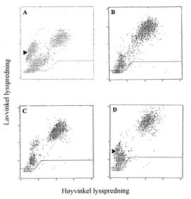 Figur 2    Serie med lysspredningsdiagrammer fra en helautomatisk blodcelleteller (CellDyn 3500) av prøve fra en pasient med…