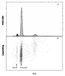 Figur 3    DNA-fordelingshistogram fra nevroblastom hos barn. A viser en dominerende aneuploid cellepopulasjon som er…