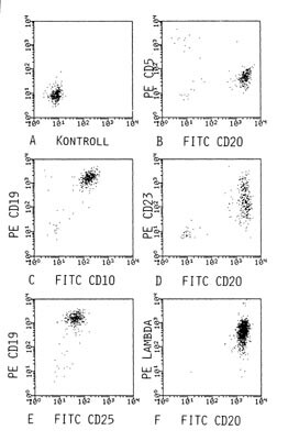 Figur 5    Tofarge fluorescenscytogrammer (FITC; fluorescin isotiocyanat, PE; fykoerytrin) fra samme pasient som i figur 2,…
