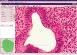 Figur 3    Utsnitt av endometriekjertel ved hyperplasi til venstre i bildet, stroma til høyre. Man registrerer hvor…