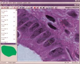 Figur 4    Utsnitt av cellekjerner i endometriekjertler ved hyperplasi. Korteste kjerneakse er vist merket i en kjerne i…