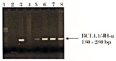 Figur 3    PCR fra pasient 1 for påvisning av translokasjon mellom kromosom 11 og 14. Det er her benyttet primere mot…