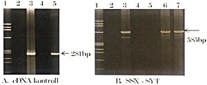 Figur 7    Revers transkriptase-PCR fra pasient 3 for påvisning av fusjonsproduktet forårsaket av t(X;18)-translokasjon. Med…