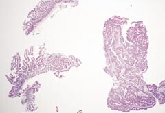 Figur 10    Lysmikroskopisk bilde av tynntarmsbiopsier fra pasient 5 (HE, 2,5 ⋅ ). Et fragment av adenokarsinom av…