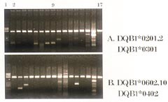 Figur 11a og b    Allelspesifikk PCR fra pasient 5 for typing av HLA DQB1-gener. Brønn 2 – 17: 16 PCR-reaksjoner. Brønn 1:…