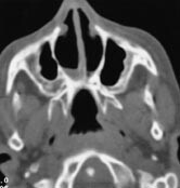 Figur 2  Aksialt CT-bilde ved dobbeltsidig koanalatresi. Septum er midtstilt. Begge siders processus pterygoideus er medialt…