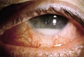 Figur 1  Akutt postoperativ endoftalmitt to dager etter kataraktoperasjon. Merk kraftig konjunktival injeksjon, uklar cornea…