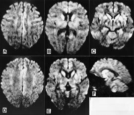 Figur 2  Aksiale (A – E) og sagittale (F) diffusjonsvektede MR-bilder (ekkoplanar; b = 1 000 sek/mm2; TR/TE = 4700/118; x, y…