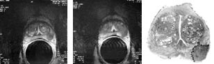 Figur 4  a, b) To aksiale endorektale MR-bilder av prostata med en tumor i den perifere sone p&aring; venstre side hvor man mente&hellip;