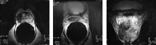 Figur 6  a, b) To aksiale endorektale MR-bilder og c) et koronalt endorektalt MR-bilde viser en tumor med b&aring;de&hellip;