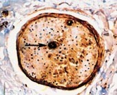 Figur 3    Mikrofotografi av nervefascikkel med immunopositivitet for lambda lette kjeder hos pasient med primær systemisk…