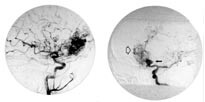  Figur 2    Cerebral angiografi hos pasient 1.  a) Sidebilde med kontrastinjeksjon i h&oslash;yre a. carotis interna viser en stor&hellip;