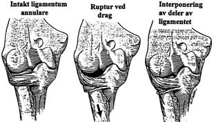  Figur 1    Patologisk anatomi vedsubluksasjon av radiushodet. Ligamentum annulare omslutter caput radii ogfester radius til…