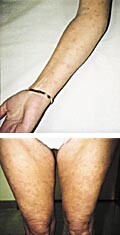 Figur 1   Hudutslett hos vår pasient fotografert fire uker etter innleggelsen. Utslettet hadde da vært nærmest uendret i to…