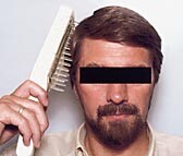  Figur 1    Behandling med UV-B-kam hos pasient med hodebunnspsoriasis. Gjengitt med pasientens tillatelse. Foto Trond-Roar…