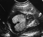 Figur 1    Ultralydbilde av foster med forstørret lever og ascites