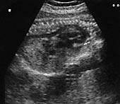 Figur 2    Ultralydbilde (lengdesnitt) av foster med forstørret hjerte (pil) og utvidet aorta