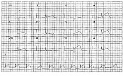 Figur 1    Faksimile av et 12-kanals EKG overført fra ambulanse til sykehus. Papirhastighet: 50 mm/s