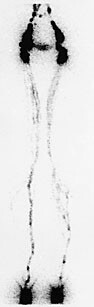  Figur 1    Normalt lymfangioscintigram fra bein. Opptak 30 minutter etter injeksjon av radiofarmakon. Det sees sterk…