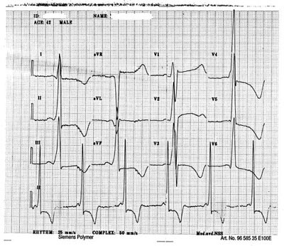  Figur 1    EKG fra pasient 1. Legg merke til kort PQ-tid og tegn til venstre ventrikkelhypertrofi med sekundære…