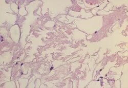 Figur 4    Pasient 2. Beinmargsbiopsi fra falang. Materialet har en nettverksliknende oppbygging med uregelmessige…