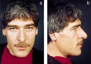  Figur 1    Diskré, men typiske trekk hos nydiagnostisert 42-årig mann med akromegali. Bildene er gjengitt med pasientens…