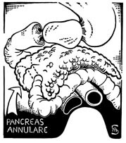 Figur 1 Pancreas annulare. Pancreashodet omslutter duodenum ringformet og kan forårsake stenose