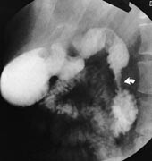 Figur 2 Røntgenundersøkelse av ventrikkel og duodenum (sidebildet). Stenose i nedadstigende del av duodenum (pil)