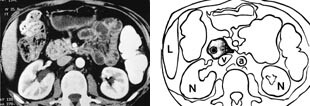 Figur 3 a) CT av pancreas annulare. Duodenum er helt omgitt av pancreasvev. b) Skisse av CT-bildet. Pancreashodet som…